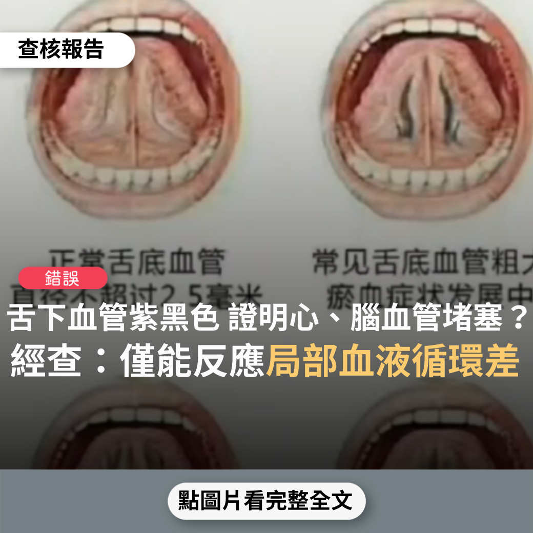 【錯誤】網傳影片稱「舌下血管瘀血成紫黑色,代表心腦血管堵塞」? - 台灣事實查核中心